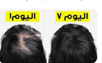 image about تكثيف وتطويل وتنعيم الشعر وعلاج فعال جدا جدا للثعلبه وعلاج فعال فى تساقط الشعر بكريم واحد فقط
