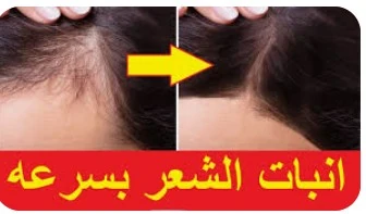 image about تكثيف وتطويل وتنعيم الشعر وعلاج فعال جدا جدا للثعلبه وعلاج فعال فى تساقط الشعر بكريم واحد فقط