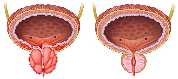 image about Prostate..امراض البروستاتا اسبابها وعلاجها والوقاية.