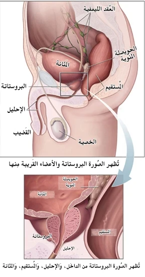 image about مسببات البروستات و طرق علاجها لدى الرجال