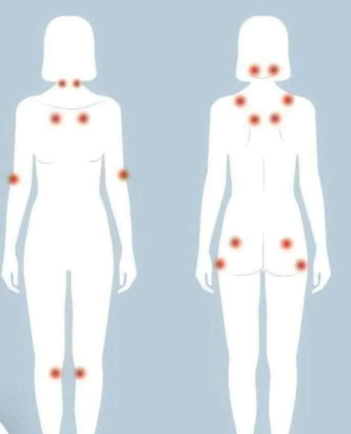image about الفيبروميالجيا: مرض يصيب النساء أكثر من الرجال
