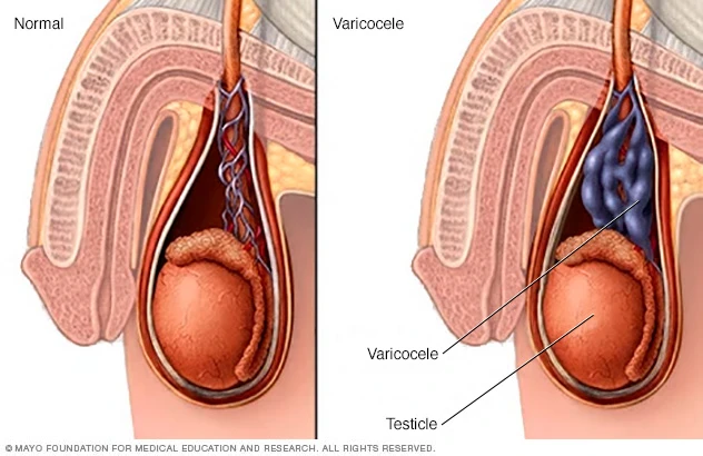 image about دوالي الخصية :الأسباب والأعراض والمضاعفات والعلاج