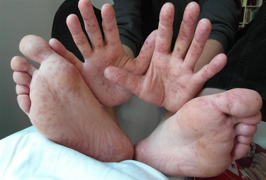 image about فيرس اليد والقدم والفم hand foot and mouth disease