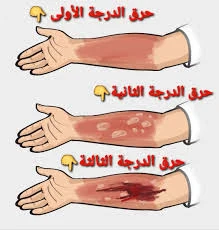 image about آثار الحروق وطرق علاجها