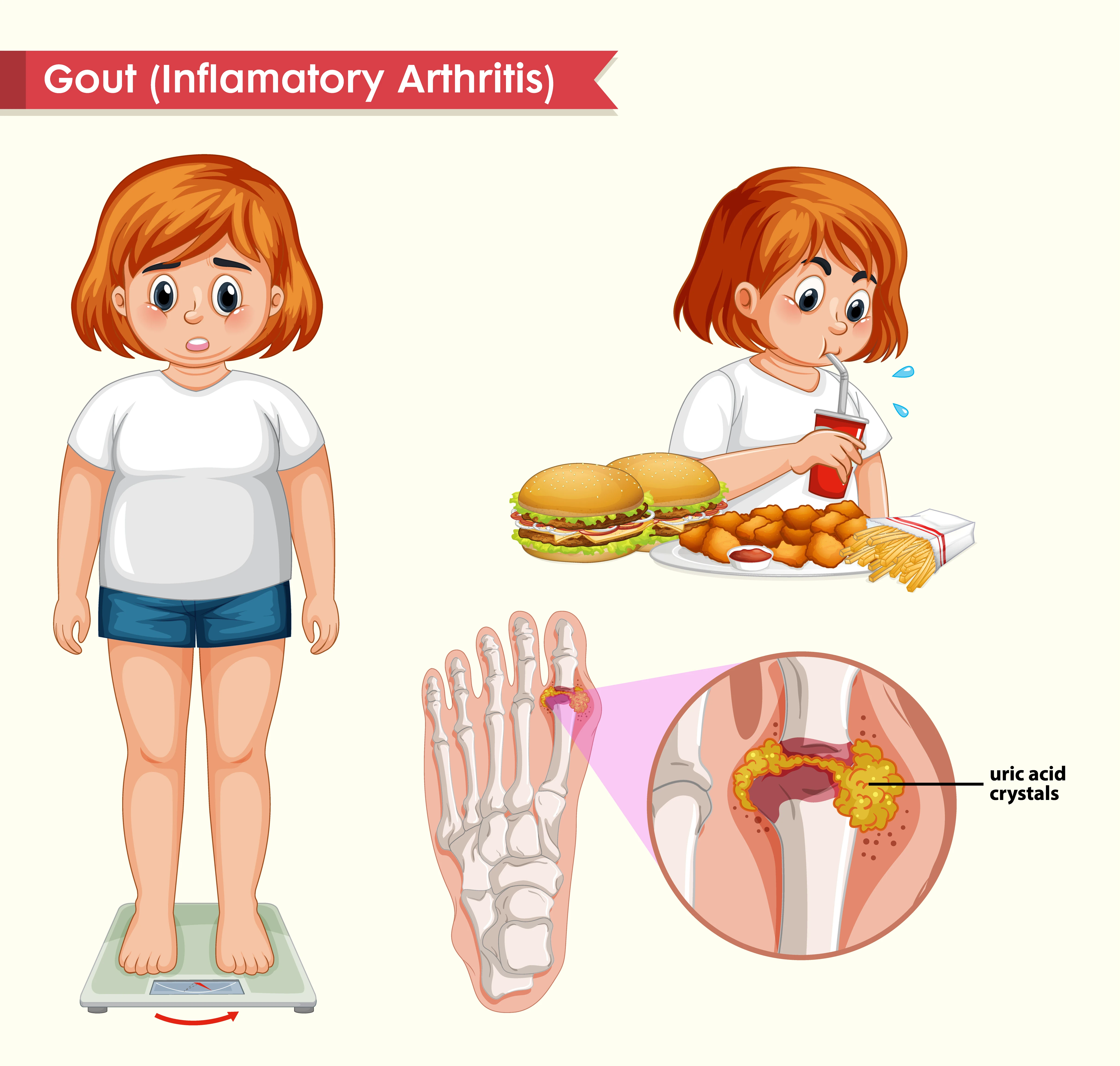 image about داء النقرس| أسبابه وأعراضه وكيفية علاجه