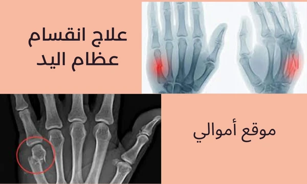 image about طرق معالجة كسر عظام اليد.