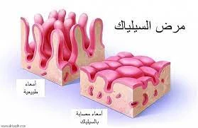 image about السيلياك مرض دون دواء  في عصر التقدم