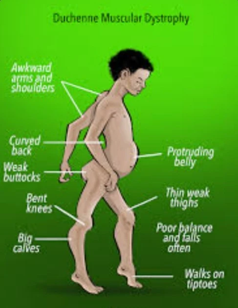 image about الضمور العضلي الدوشيني: أسبابه وأعراضه ودور التغذية العلاجية في العلاج