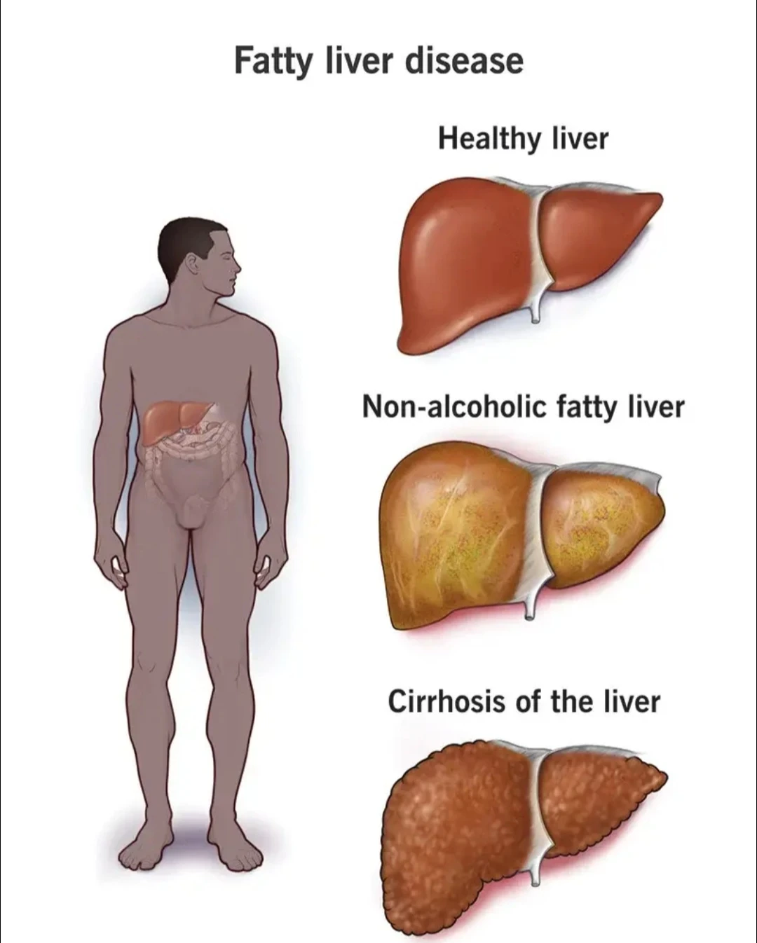 image about Fatty Liver: Causes, Types, Symptoms, Treatment, and the Essential Role of Nutrition