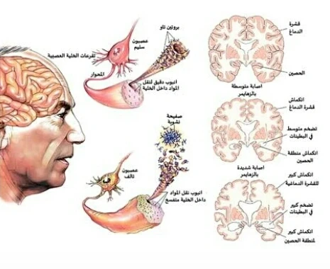 image about الزهايمر تحدي العصر الذهبي