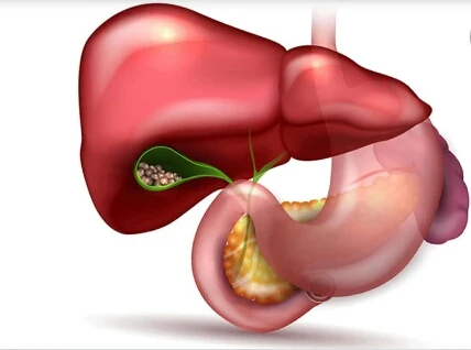 image about المراره الملتهبه المؤلمه
