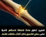 image about علاج العظام فى دقائق ثورة الطب الحيوي المعاصر – ابتكار اللاصق الطبي Bone-02 لعلاج كسور العظام