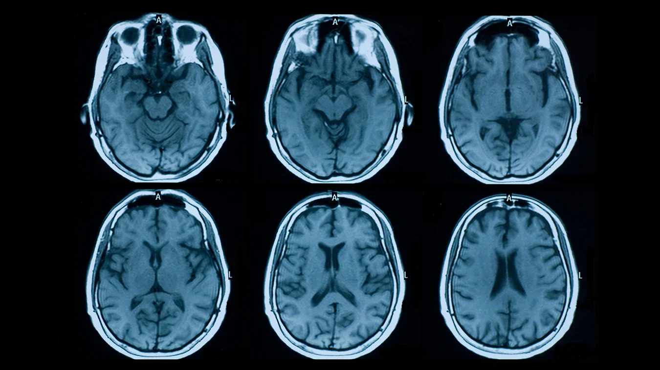 image about دليل التغذية العلاجية لمرضى التصلب المتعدد (MS): الأطعمة المسموحة والممنوعة
