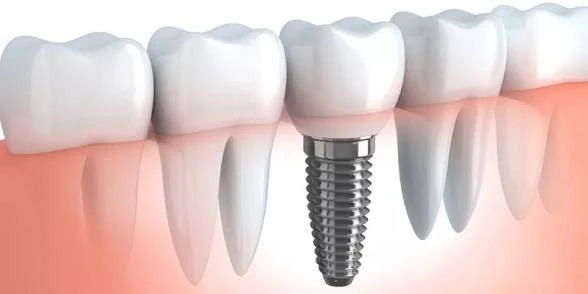 image about زراعة الأسنان: الحل الحديث لاستعادة الابتسامة