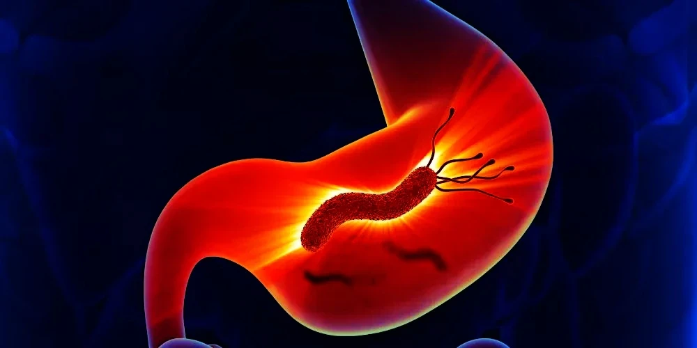 image about جرثومة المعدة : الأعراض ،والمضاعفات ، والأسباب ، وطرق العلاج والوقايه