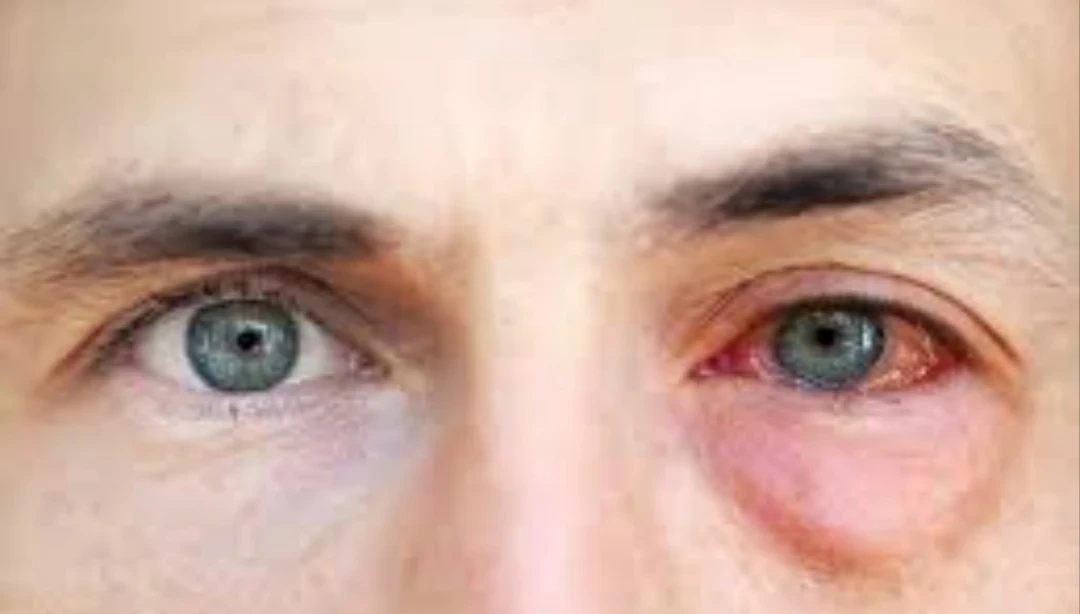 image about حساسية الضوء عندما يصبح الضوء عذاب 
