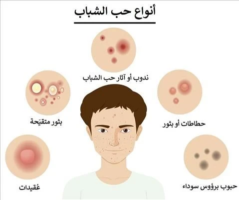 image about حب الشباب ليس مجرد حبوب عابرة..   الأسباب الخفية التي تدمر بشرتك وكيف تتخلص منها نهائيًا