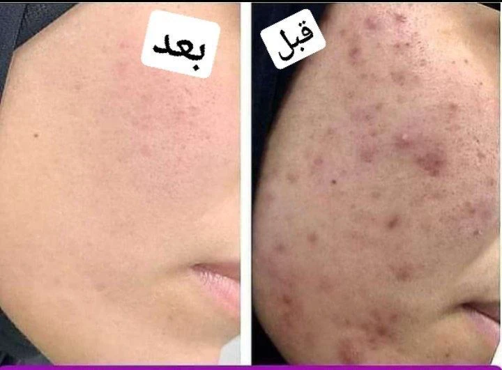 image about العناية بالبشرة الدهنية: دليلك الشامل لبشرة صافية ومطفية طول اليوم*