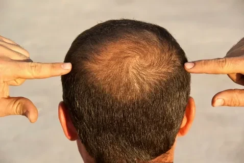 image about علاج الصلع الوراثي.. أحدث الطرق لاستعادة كثافة الشعر والحد من التساقط