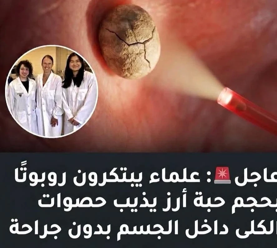 image about بشرى لمرضى حصوات الكلى: ثورة هادئة قادمة من مختبرات جامعة واترلو