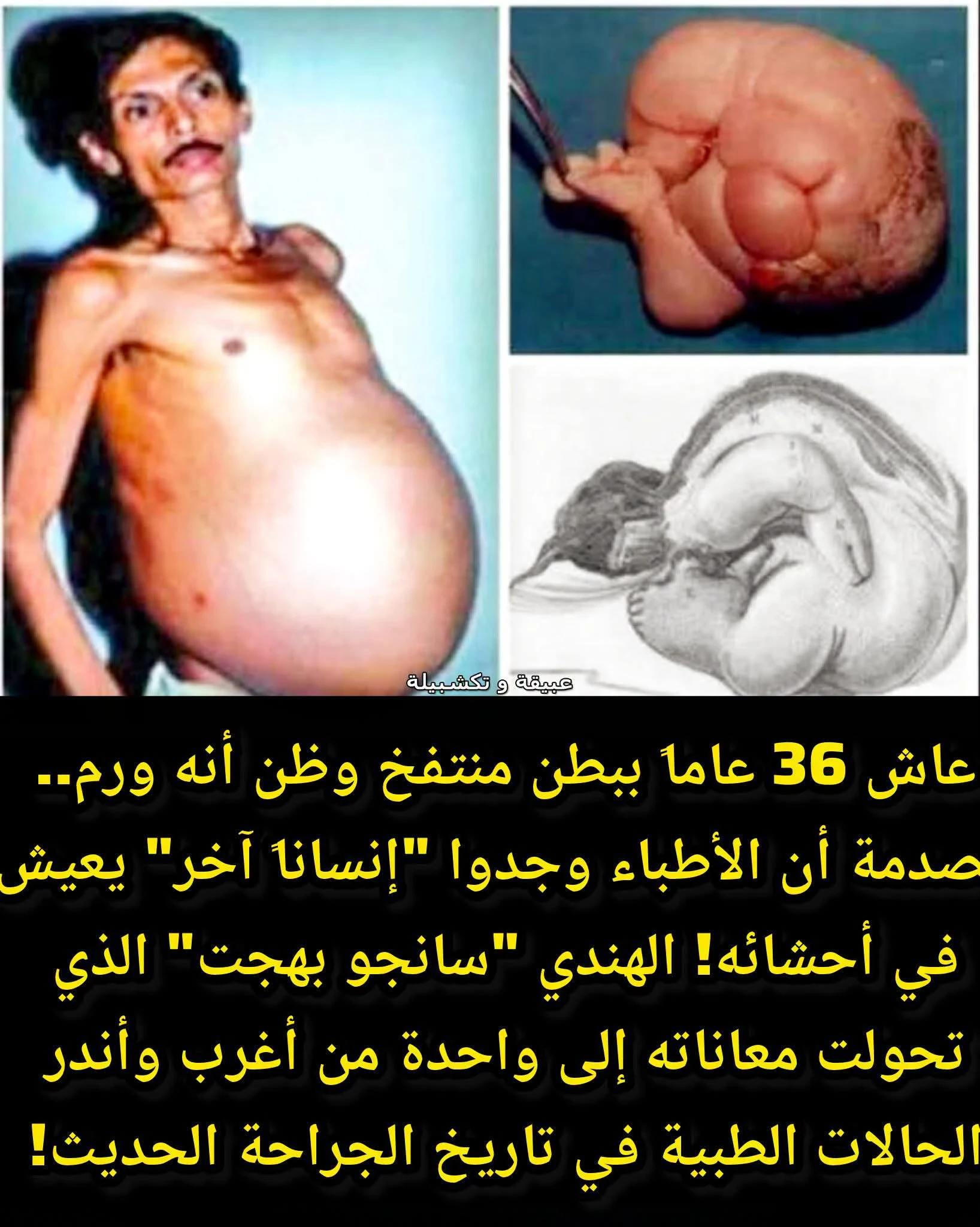image about قصة مذهلة لا تُصدق: عاش 36 عامًا يحمل