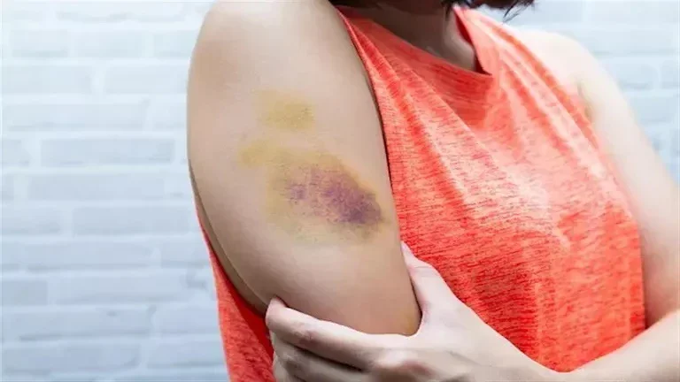 image about أسباب ظهور كدمات عند الاستيقاظ صباحًا.. متى تكون طبيعية ومتى تستدعي زيارة الطبيب؟