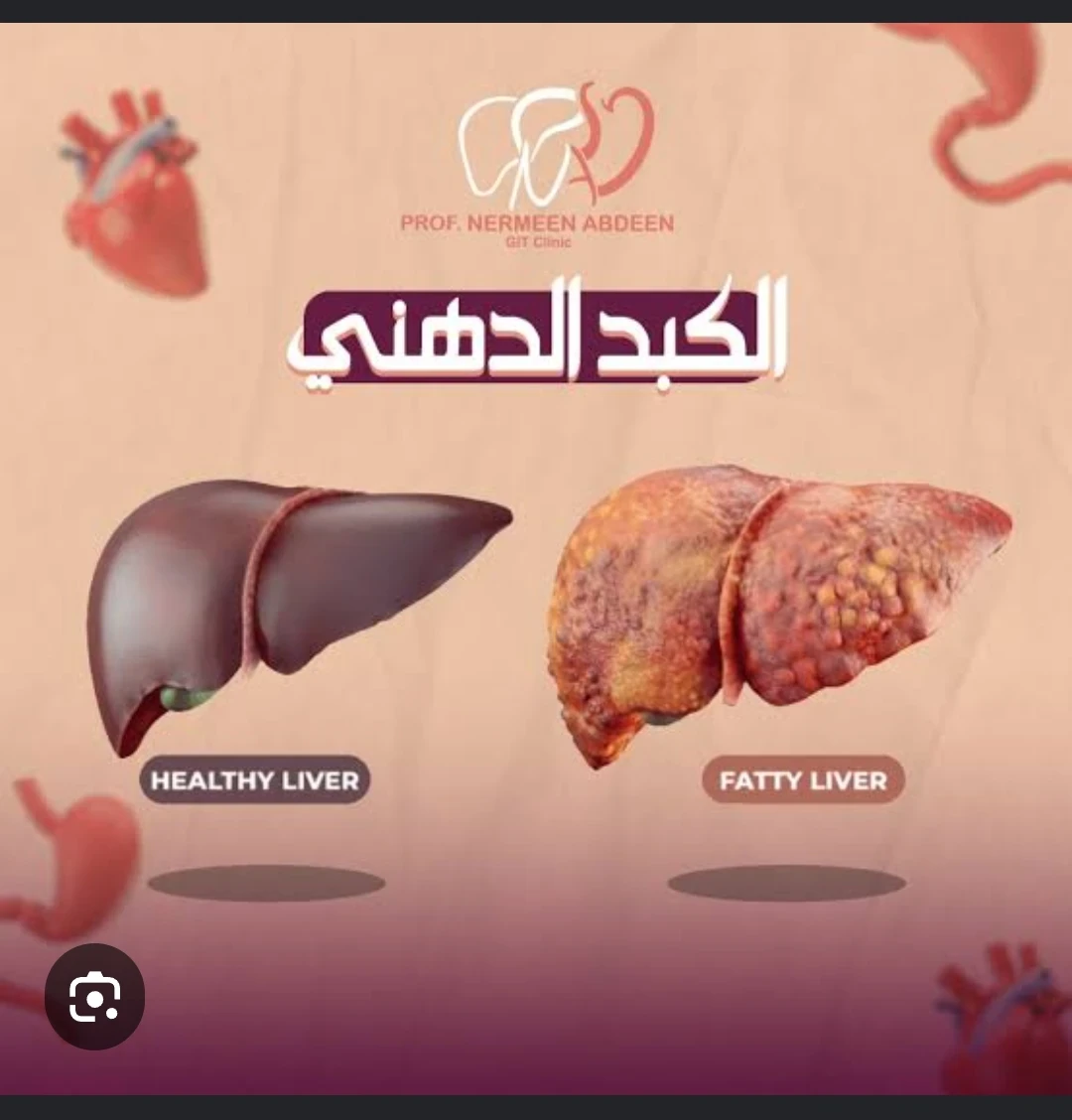 image about دهون الكبد: العدو الصامت.. كيف تتكون وكيف تستعيد كبدك؟