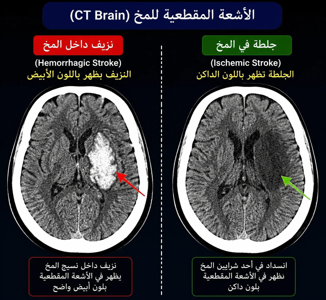 image about تعمل ايه لو شكيت في جلطه في المخ
