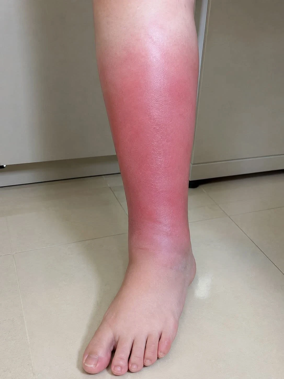 image about الالتهاب الخلوي تعريفه واعراضه والتشخيص والعلاج Cellulitis