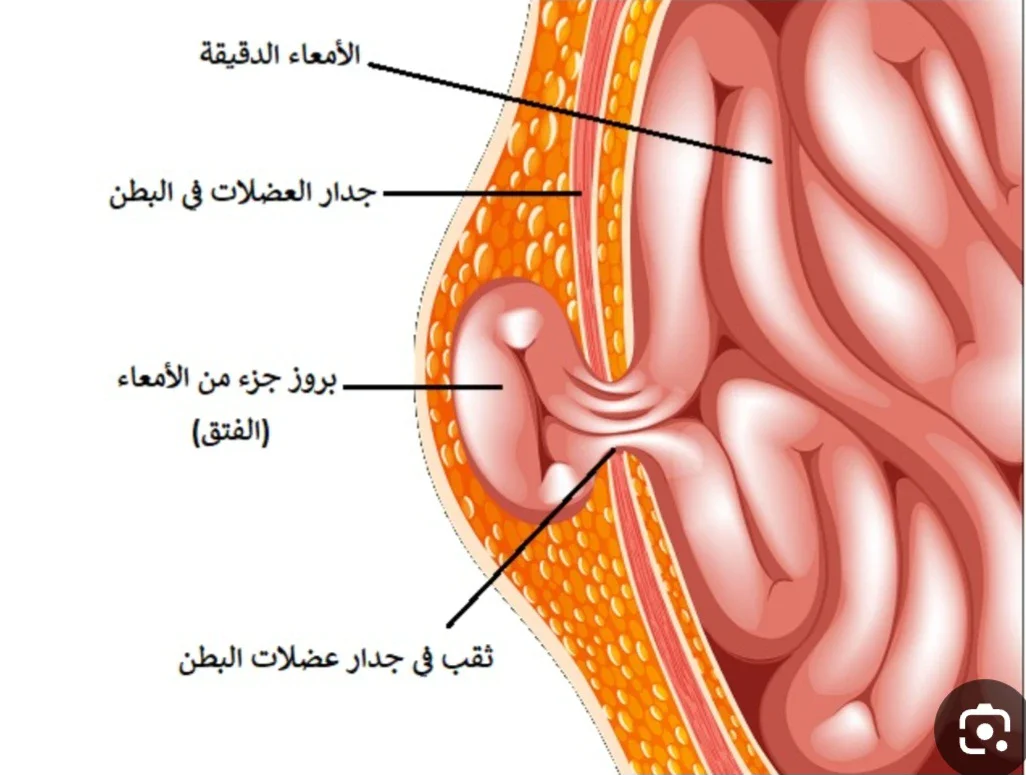 image about يعني إيه فتاق أو فتق أو عَرَق؟ Hernia