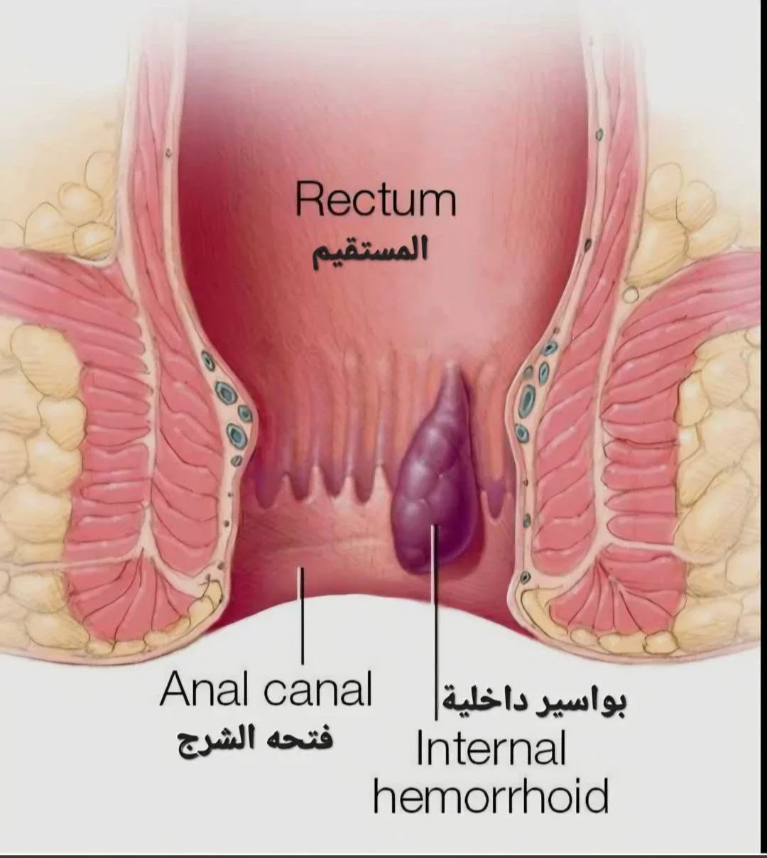 image about للنزيف من فتحة الشرج وهو ⬅️ البواسير.. (Hemorrhoid