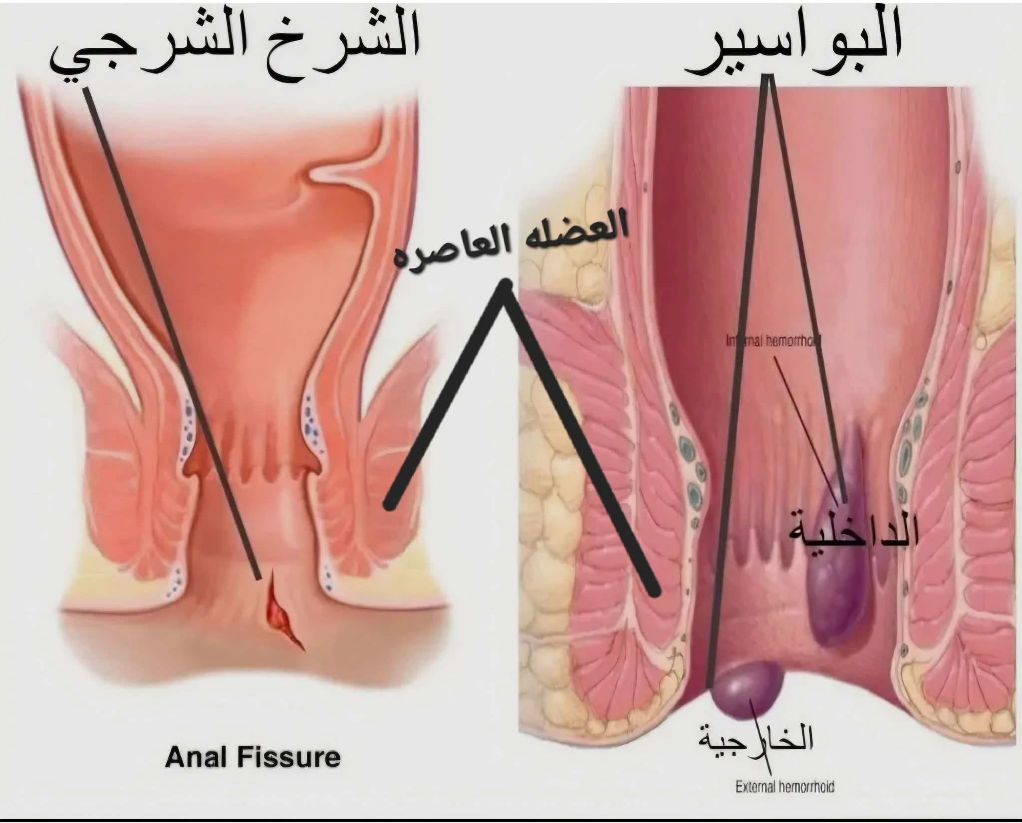 image about هنتكلم عن البواسير الخارجية، والشرخ الشرجي