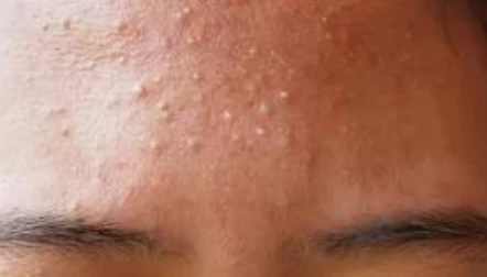image about ازاى تعرف نوع الحبوب فى وشك؟ (الفرق بين حب الشباب والحب الفطري والوردية)