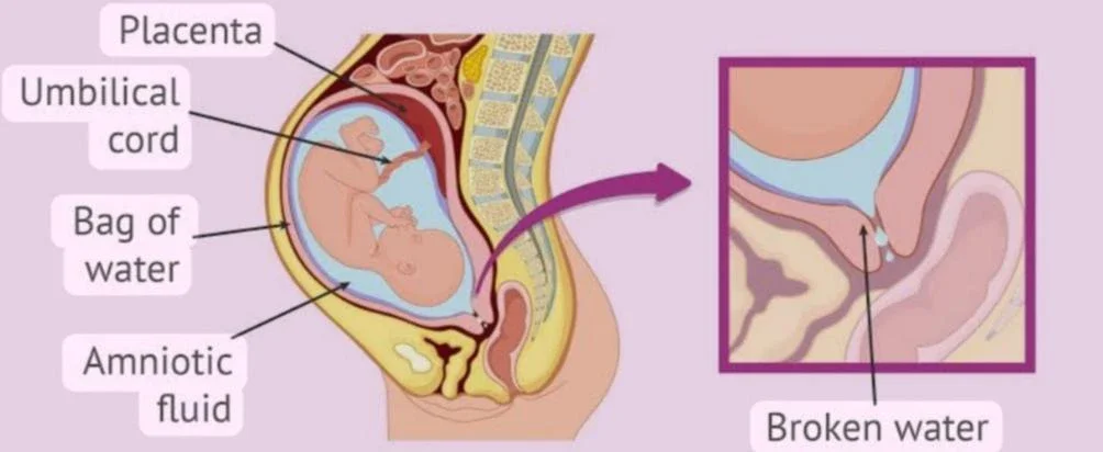 image about تمزق الأغشية المبكر أثناء الحمل الأسباب، الأعراض، التشخيص، المضاعفات،و العلاج (Premature rupture of membrane) 