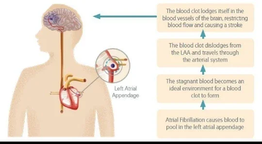 image about ماذا يحدث للقلب عندما يختل إيقاعه