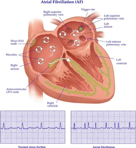 image about ماذا يحدث للقلب عندما يختل إيقاعه