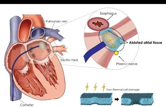 image about ماذا يحدث للقلب عندما يختل إيقاعه