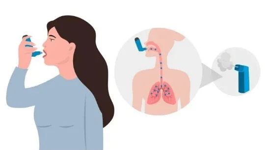 image about الربو التحسّسي وأحدث علاجات حساسية الصدر: ماذا تغيّر في علاج المرض؟