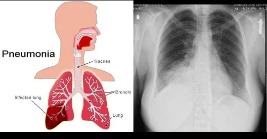 image about الالتهاب الرئوي: كيف تبدأ العدوى داخل الرئة وما أحدث طرق علاجه؟