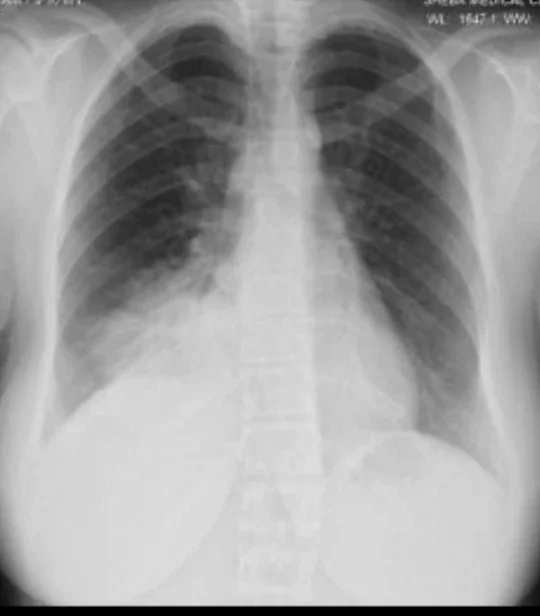 image about الالتهاب الرئوي: كيف تبدأ العدوى داخل الرئة وما أحدث طرق علاجه؟