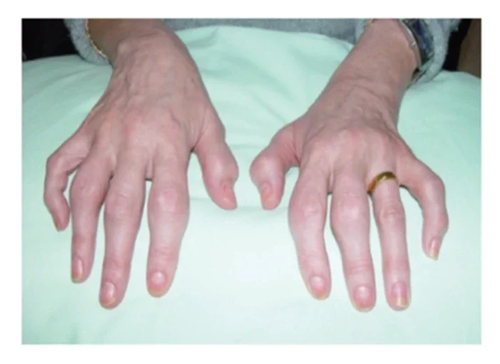 image about إصبع الذهب.. خاتم زواج حيّر الأطباء: هل يستطيع الذهب حماية المفاصل؟