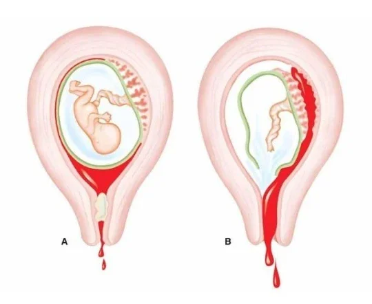 image about نزول الدم أثناء الحمل: متى يكون إنذارًا يستحق الانتباه؟