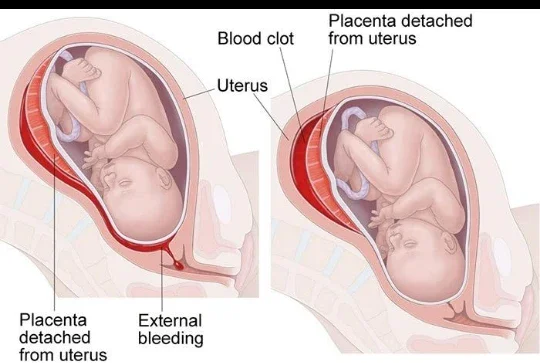 image about نزول الدم أثناء الحمل: متى يكون إنذارًا يستحق الانتباه؟