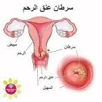 image about السرطان: ما هو؟ وكيف يصيب الإنسان؟ ولماذا ينتشر في بعض الدول أكثر من غيرها؟