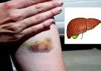 image about تليف الكبد وسرطان الكبد: الأسباب والأعراض والعلاقة بينهما