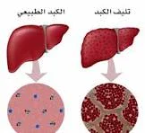 image about عندما يتقدم التليف