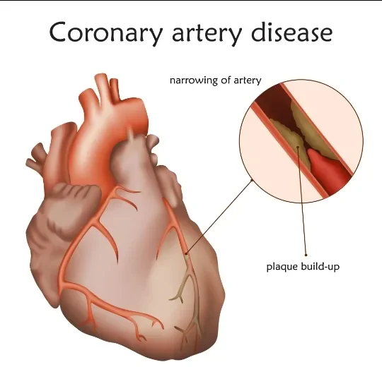 image about Coronary Artery Disease: How It Develops and Its Symptoms