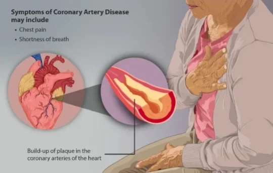 image about Coronary Artery Disease: How It Develops and Its Symptoms