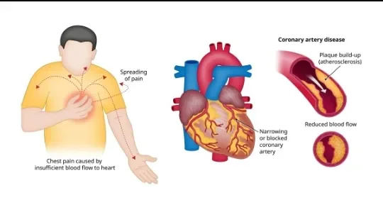image about Coronary Artery Disease: How It Develops and Its Symptoms