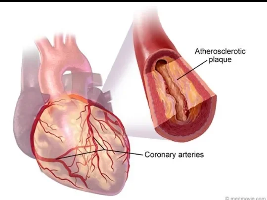 image about Coronary Artery Disease: How It Develops and Its Symptoms